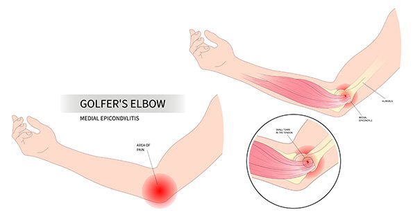 Golfer's elbow