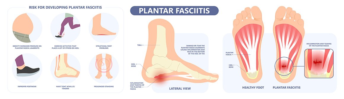 Shockwave Therapy For Plantar Fasciitis​