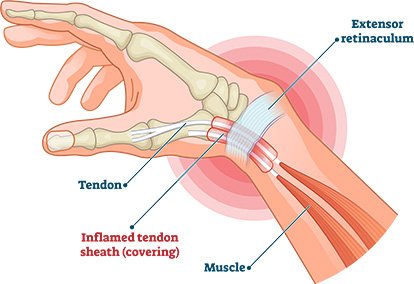 Tenosynovitis​