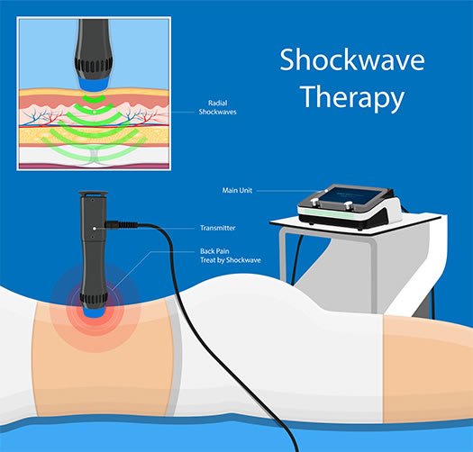 Shockwave Therapy ️