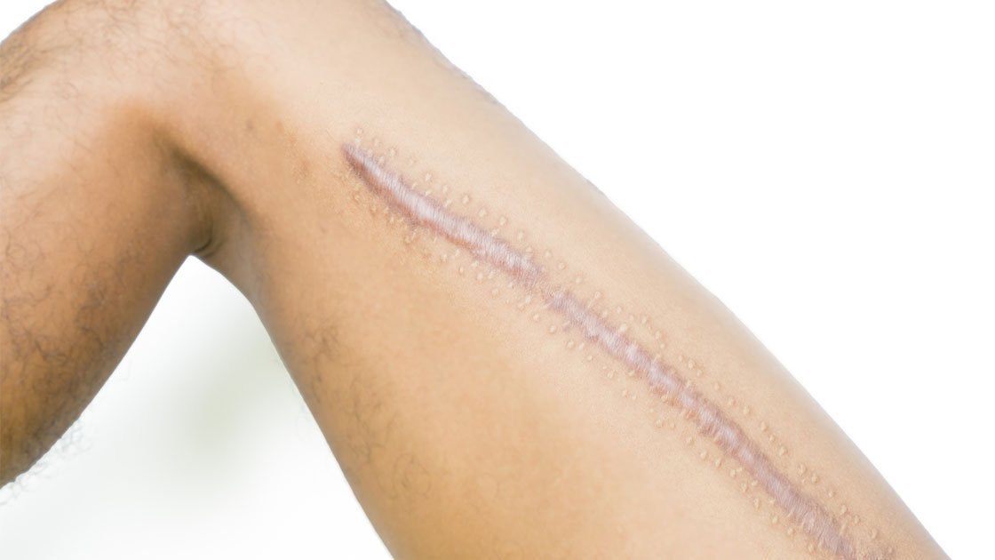 Shattering Scars How Shockwave Therapy Is Transforming Scar Tissue Treatment