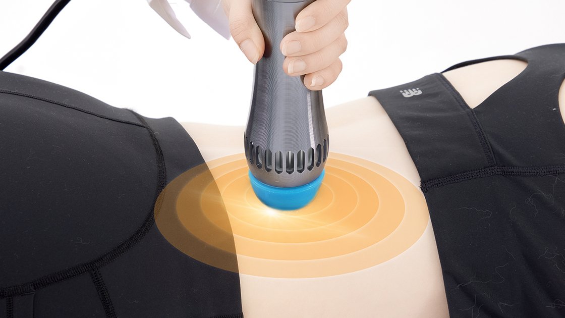 Shockwave Therapy for Hip Bursitis